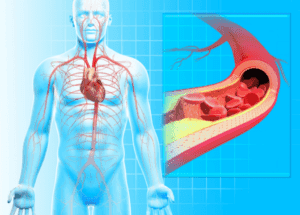 atherosclerosis