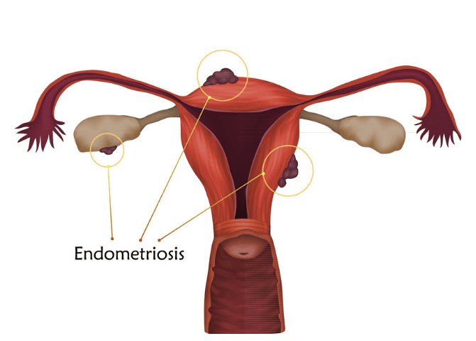 Tendometriosis