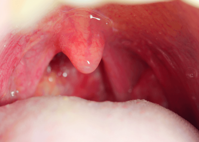 pharyngitis