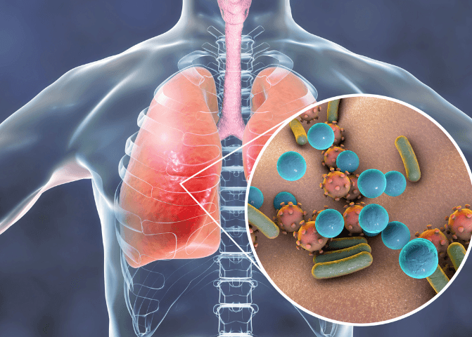 chest infections are caused by viruses and bacteria