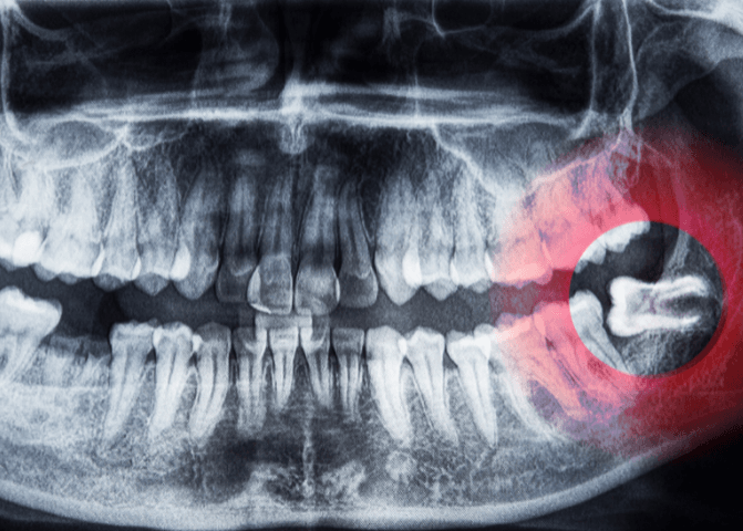 impacted wisdom tooth